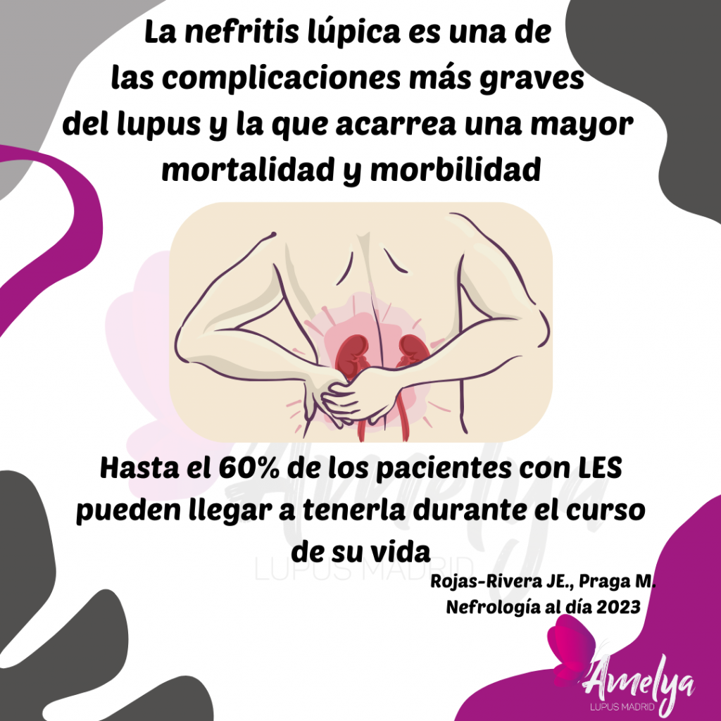 La nefritis lúpica es una de 
las complicaciones más graves 
del lupus y la que acarrea una mayor 
mortalidad y morbilidad.

Hasta el 60% de los pacientes con LES pueden llegar a tenerla durante el curso de su vida